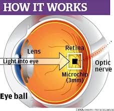 پژوهشگران با پیوند تراشه ای در چشم بینایی را به برخی نابینایان باز می گردانند